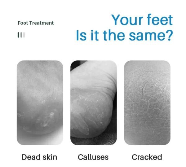 Foot Peeling Spray with Natural Essence Pedicure - Image 2