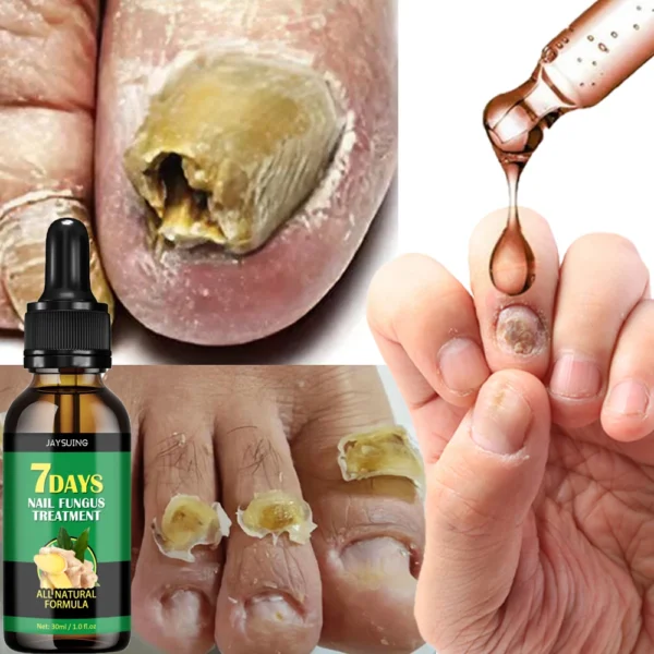 Nail Fungal Treatment extra strength - Image 2
