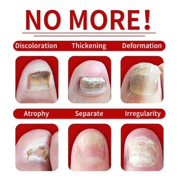 Nail Fungal Treatment extra strength - Image 3