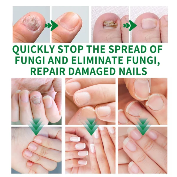 Nail Fungal Treatment extra strength - Image 4