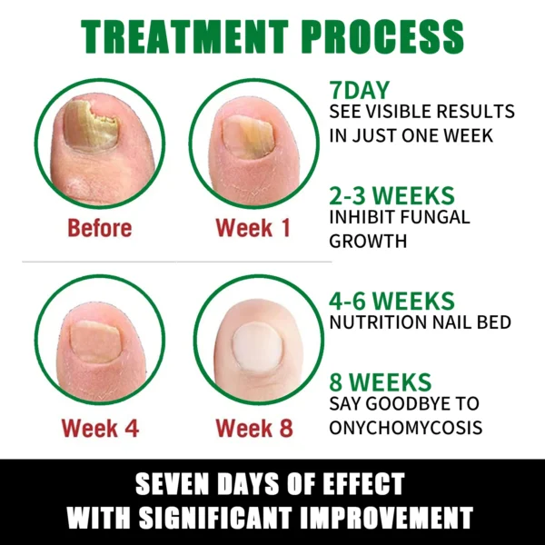 Nail Fungal Treatment extra strength - Image 5