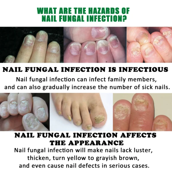 Nail Fungal Treatment extra strength - Image 6