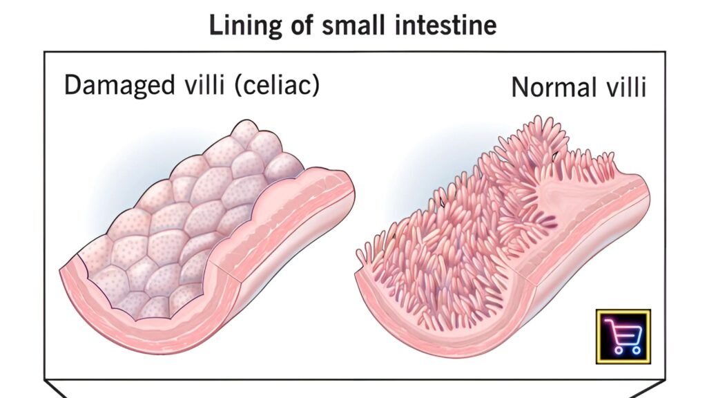 A graphic showing the difference between healthy villi and damaged villi in the small intestine due to celiac disease.